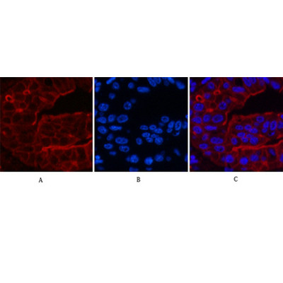  Immunofluorescence analysis of Human-liver-cancer tissue. 1,ABCB5 Monoclonal Antibody(11A2)(red) was diluted at 1:200(4°C,overnight). 2, Cy3 labled Secondary antibody was diluted at 1:300(room temperature, 50min).3, Picture B: DAPI(blue) 10min. Picture A:Target. Picture B: DAPI. Picture C: merge of A+B